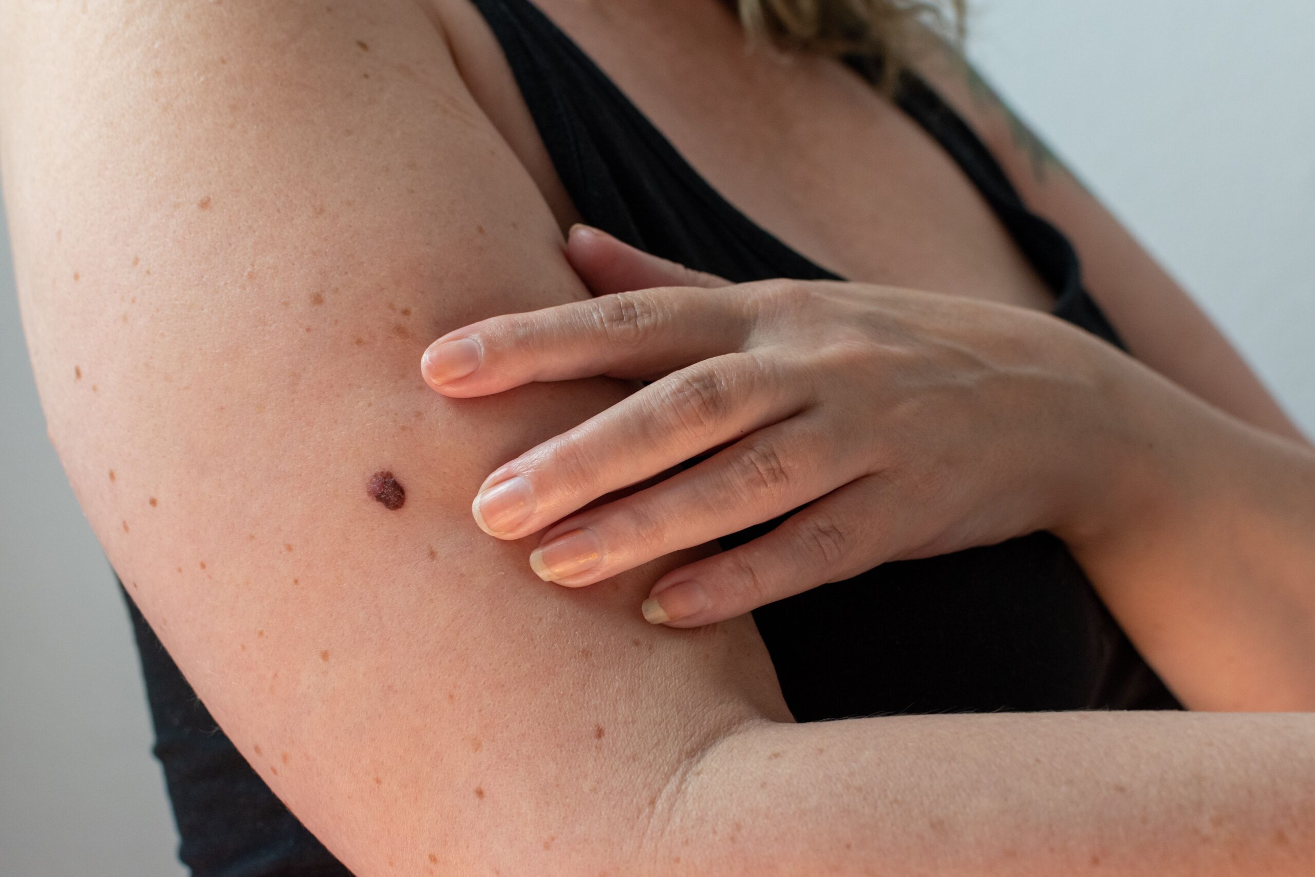 Survivors of early-stage melanoma have high rates of fear of recurrence, study finds